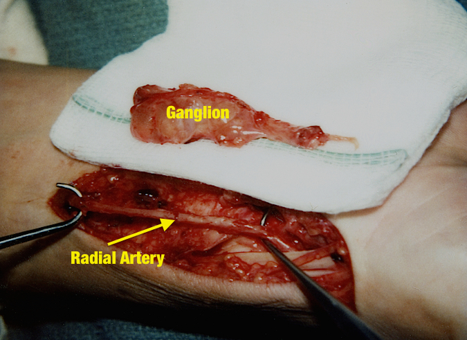 Ganglion Wrist Hand Fingers Hand Surgery Resource